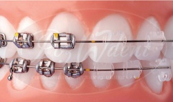 Braces in the dental center "InStom"